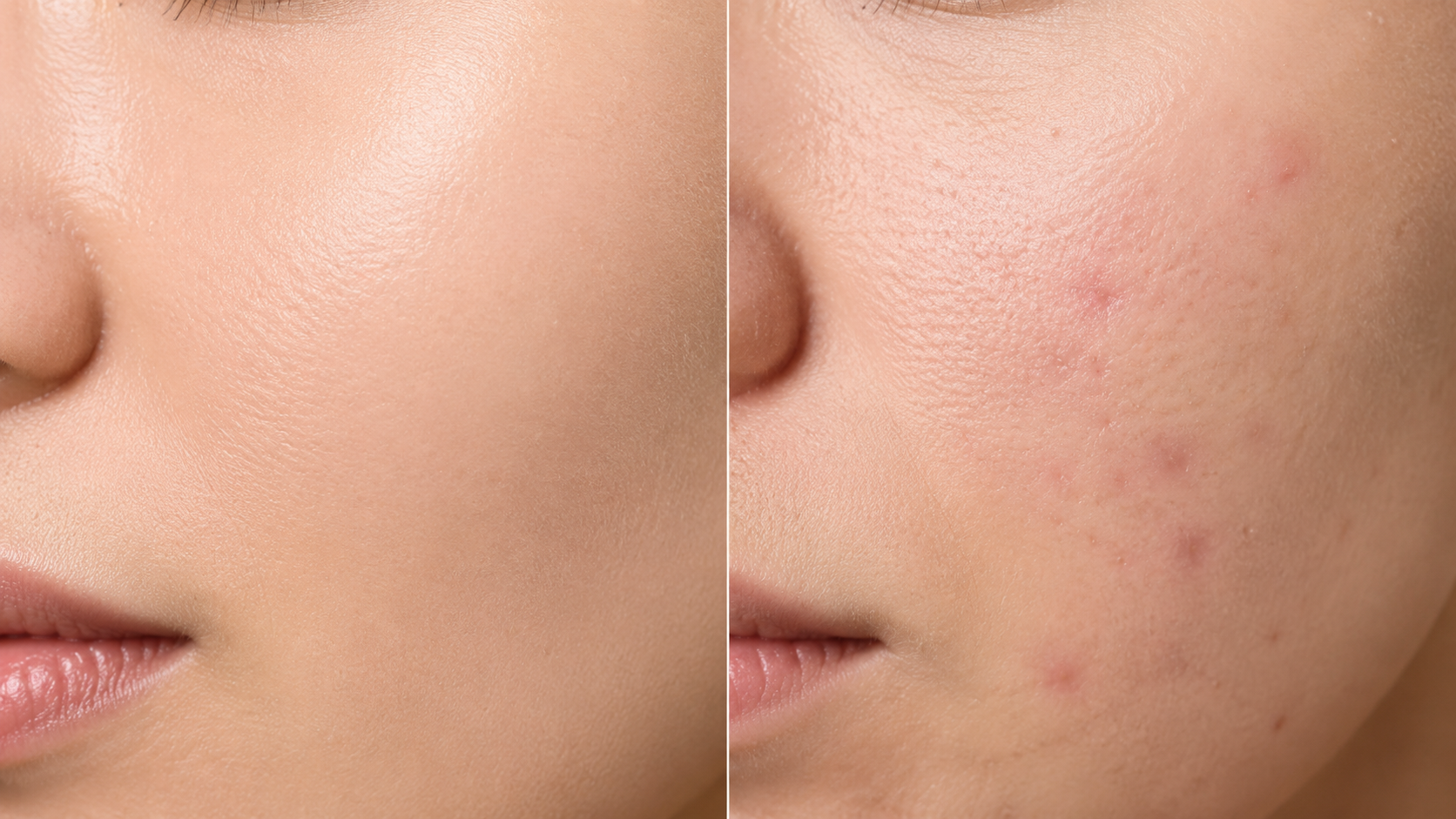 Pimple vs acne difference, types of acne and spot treatment for clear skin